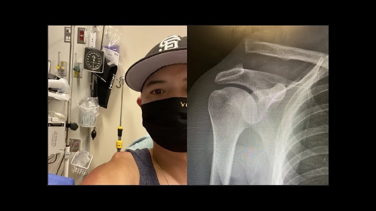 My recovery from AC joint separation grade V
