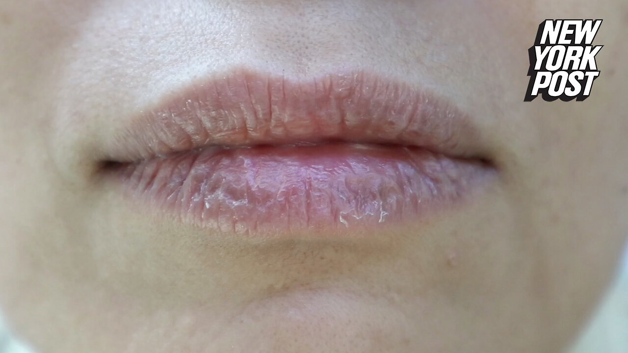 I'm a doctor – here's how to avoid chapped lips