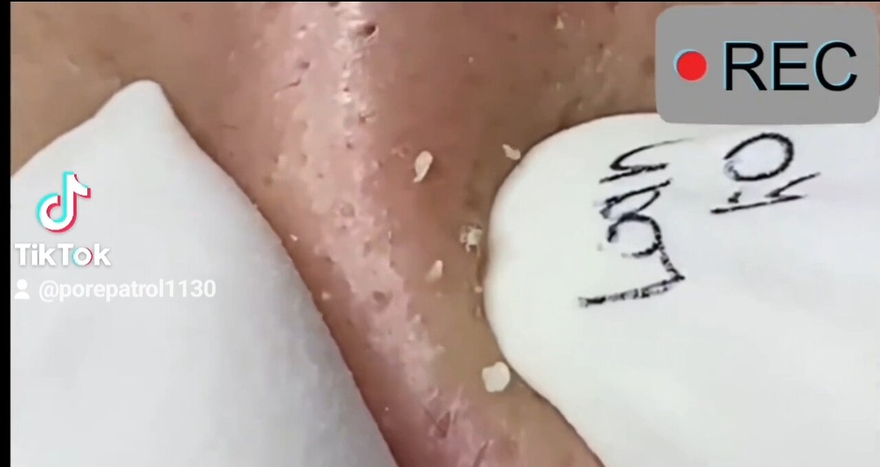 Amazing Whiteheads Removal!