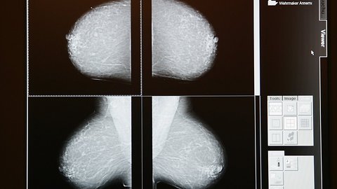 FDA Mammography Rule Proposal Would Alert Women To Breast Cancer Risk