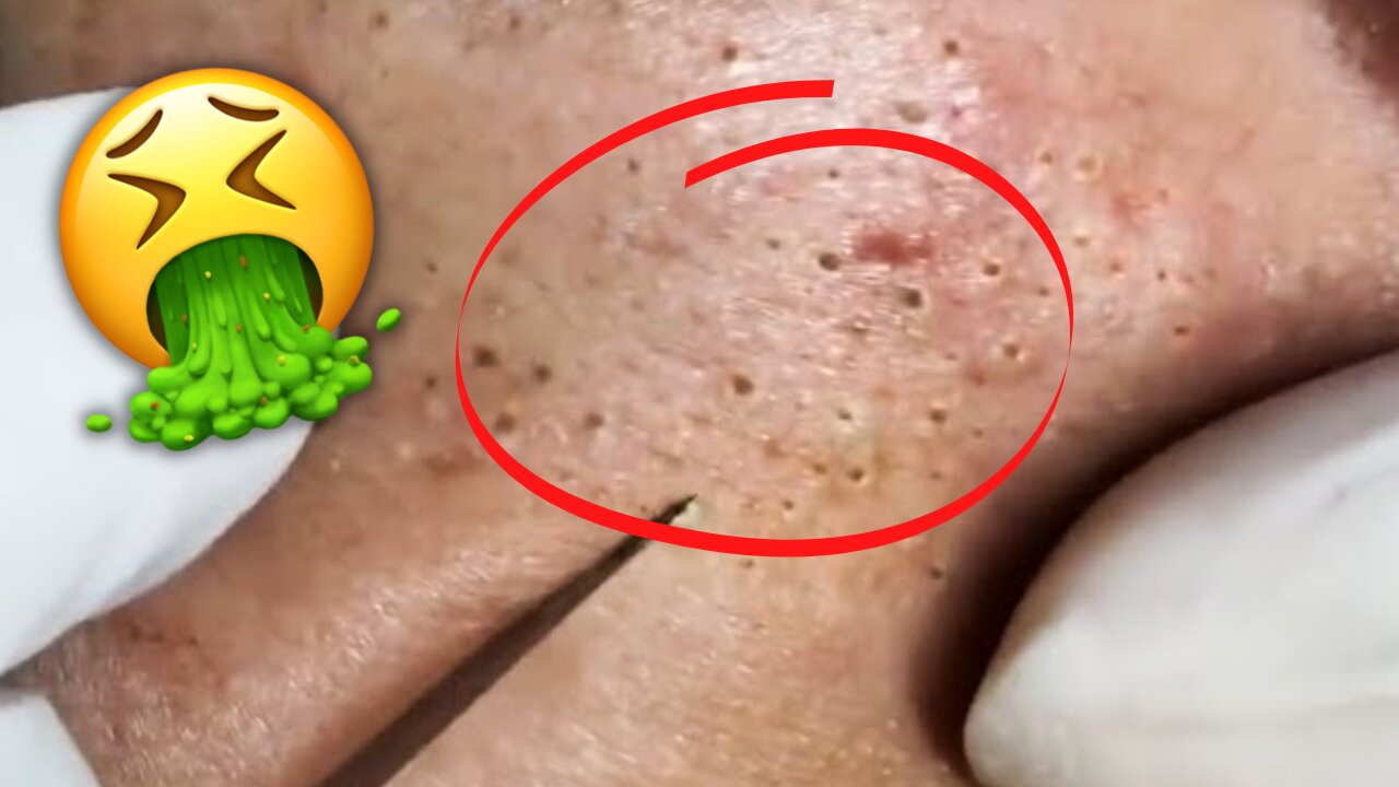 Remove Blackheads Relaxing Procedure in 2021 | Part II