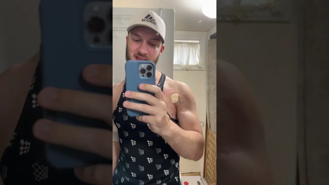 Wound Dressings Causing Irritation? 70 days in.