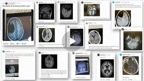 The mRNA Injections gave the Vaxxed a Lobotomy.😳🤯🧠 Wow, they really do have brain damage.😔💔