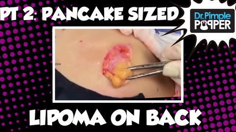 Part 2: A Pancake-Sized Lipoma on the Back with Dr Pimple Popper