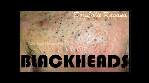 Blackheads Removal