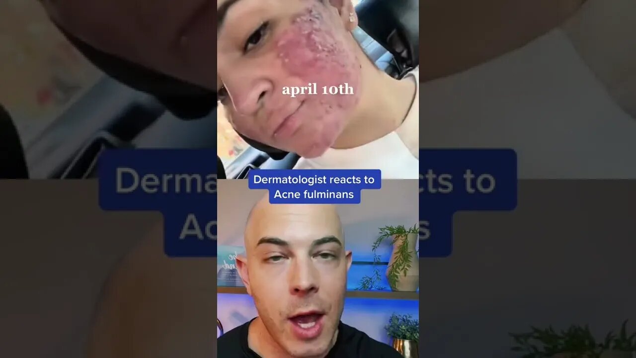 Amazing acne transformation with Accutane