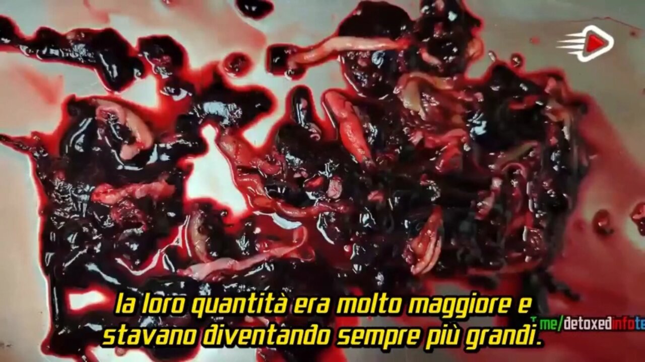 Coaguli nelle arterie dei cadaveri vaccinati - dal film documentario DIED SUDDENLY