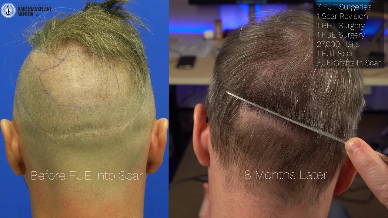 Can FUE Grafts Camouflage an FUT Scar? My FUE 8 Month Update.