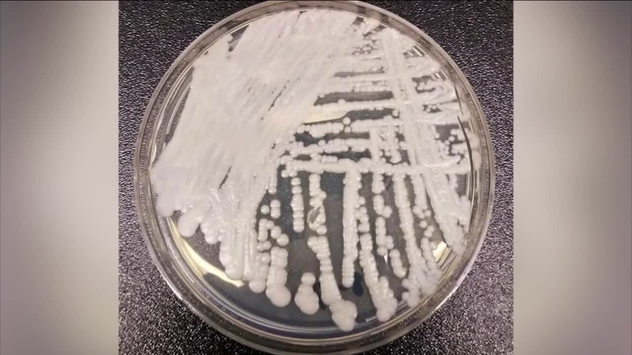 Two cases of Candida Auris reported in Colorado. What it means