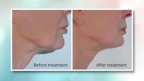 A must see! Learn about a minimally invasive treatment that stimulates the natural production of collagen