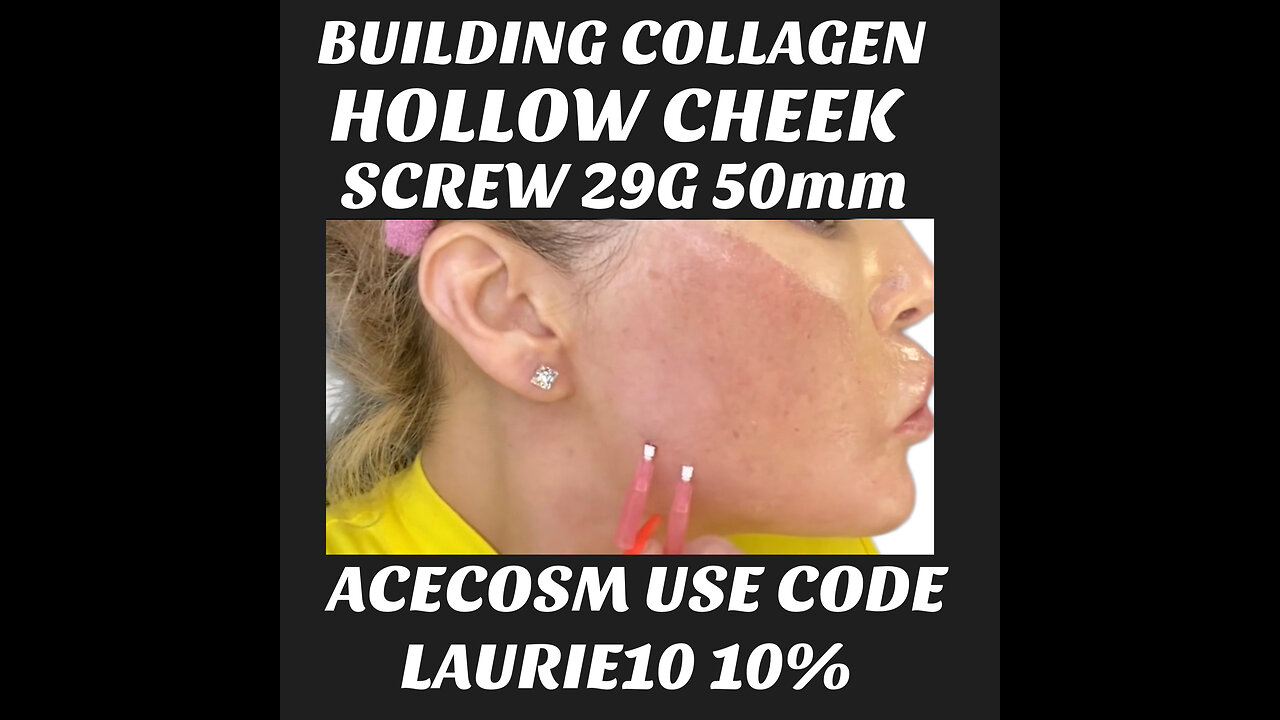 Building Collagen in Cheek Hollowness A Huge Differnce
