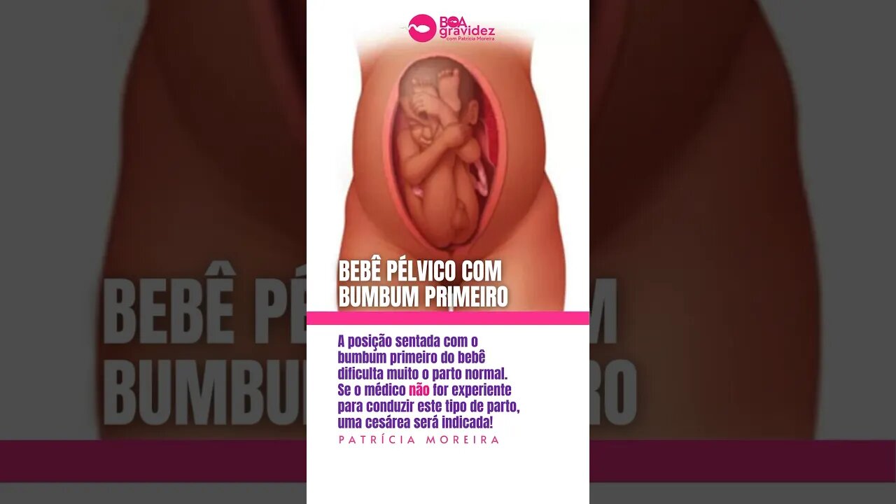 Bebê pélvico com bumbum primeiro