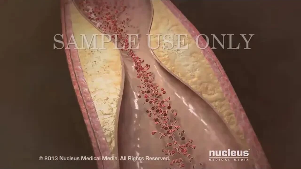 Derivación o Revascularización Coronaria (CABG)
