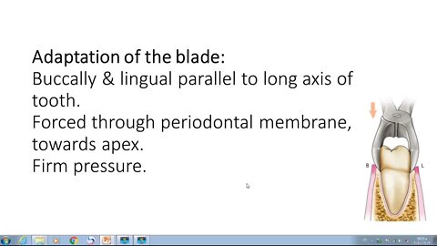 Oral Surgery L13 (Simple Tooth Extraction)