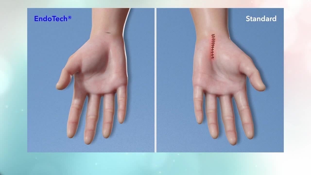 EndoTech is a state-of-the-art surgery system for hand and wrist conditions at Fitzmaurice Hand Institute