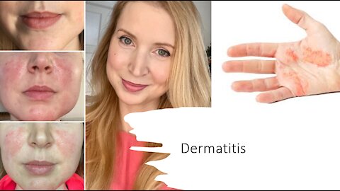 Dermatitis - Natural Treatment