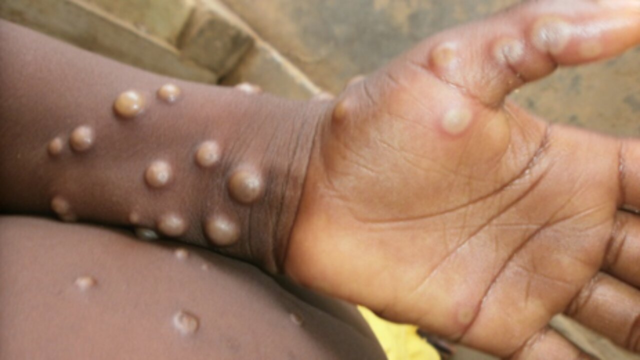 HOW TO TREAT AND ALSO PREVENT MPOX OR MONKEY POX THAT IS A NEW KILLER DISEASE