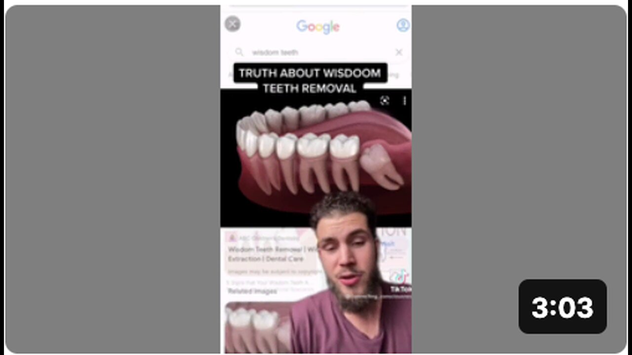 The truth on why they remove the wisdom teeth