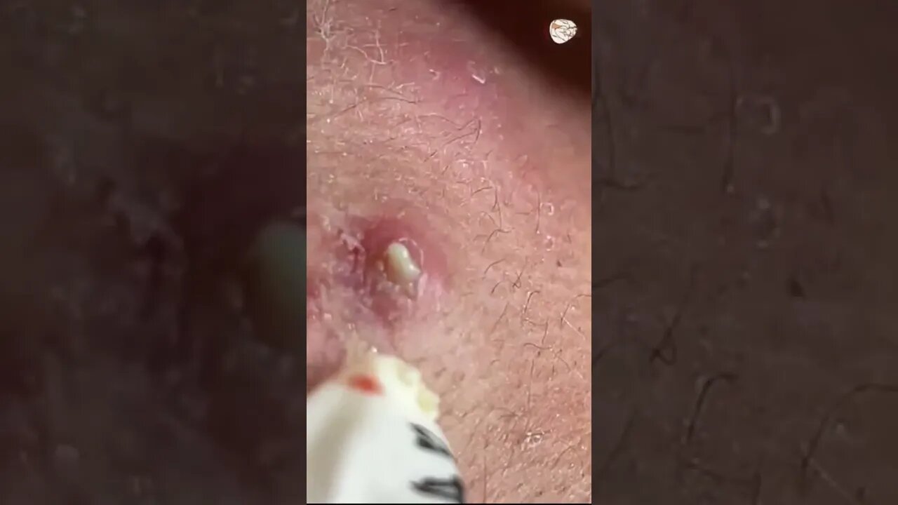 Yes, yes, YES!!!! Pimple Popper Blackheads