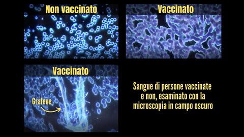 NWO, VACCINI: Cosa scorre nelle vene? Grafene e globuli rossi impilati