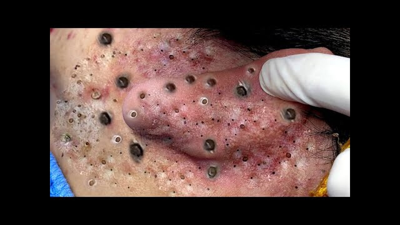Say Goodbye to Blackheads Forever! #Skincare #BlackheadRemoval #ViralTips