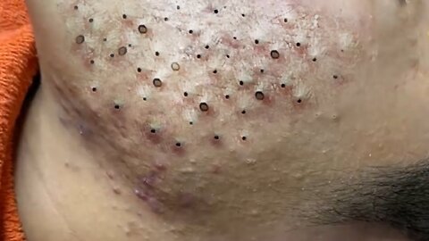 Blackheads, Blackhead Removal, Acne Extraction Relaxing #54