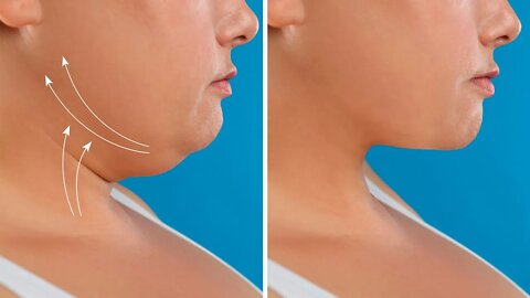 How To Get Rid Of Double Chin Naturally