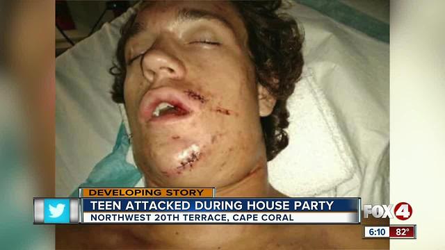 Teen recovering after being jumped at Cape party