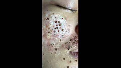 blackhead