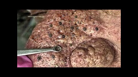 Blackheads Removal