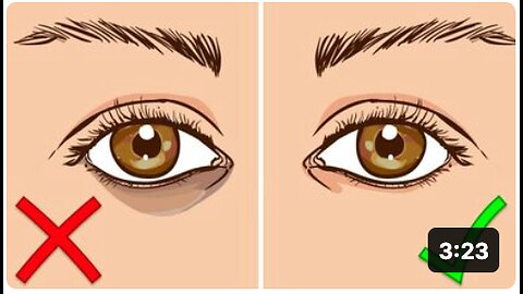 How To Get Rid Of Dark Circles Under Your Eyes