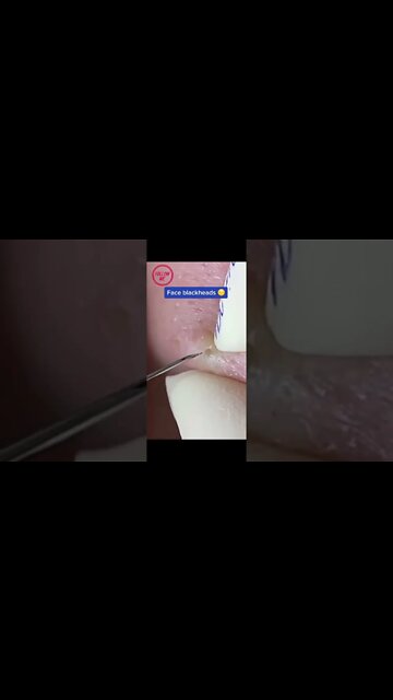 Enormous Face Blackheads - Profesionnal extraction
