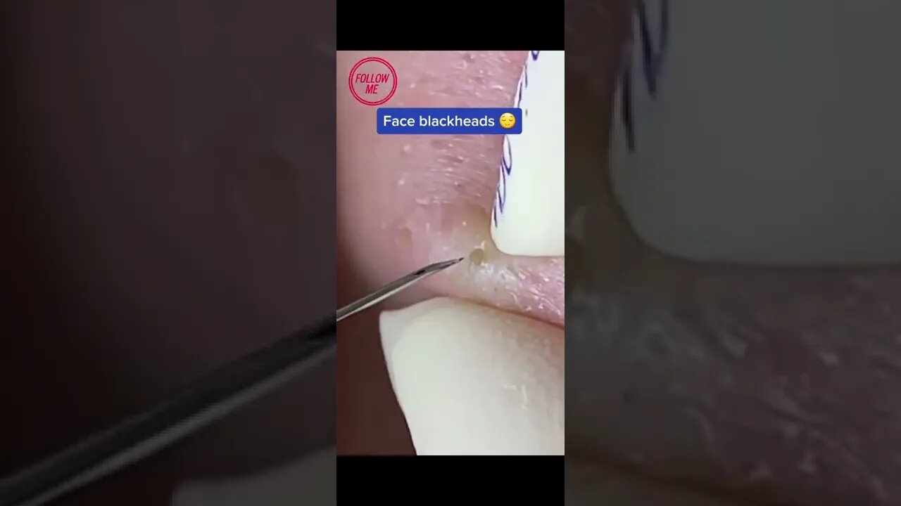 Enormous Face Blackheads - Profesionnal extraction