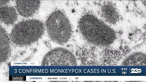 CDC monitoring U.S. monkeypox cases