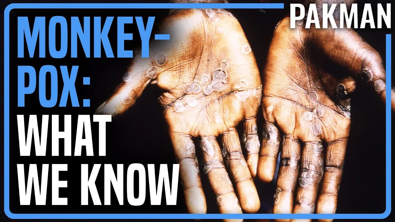 OH NO: Monkeypox Outbreak, Possibly Through Sex