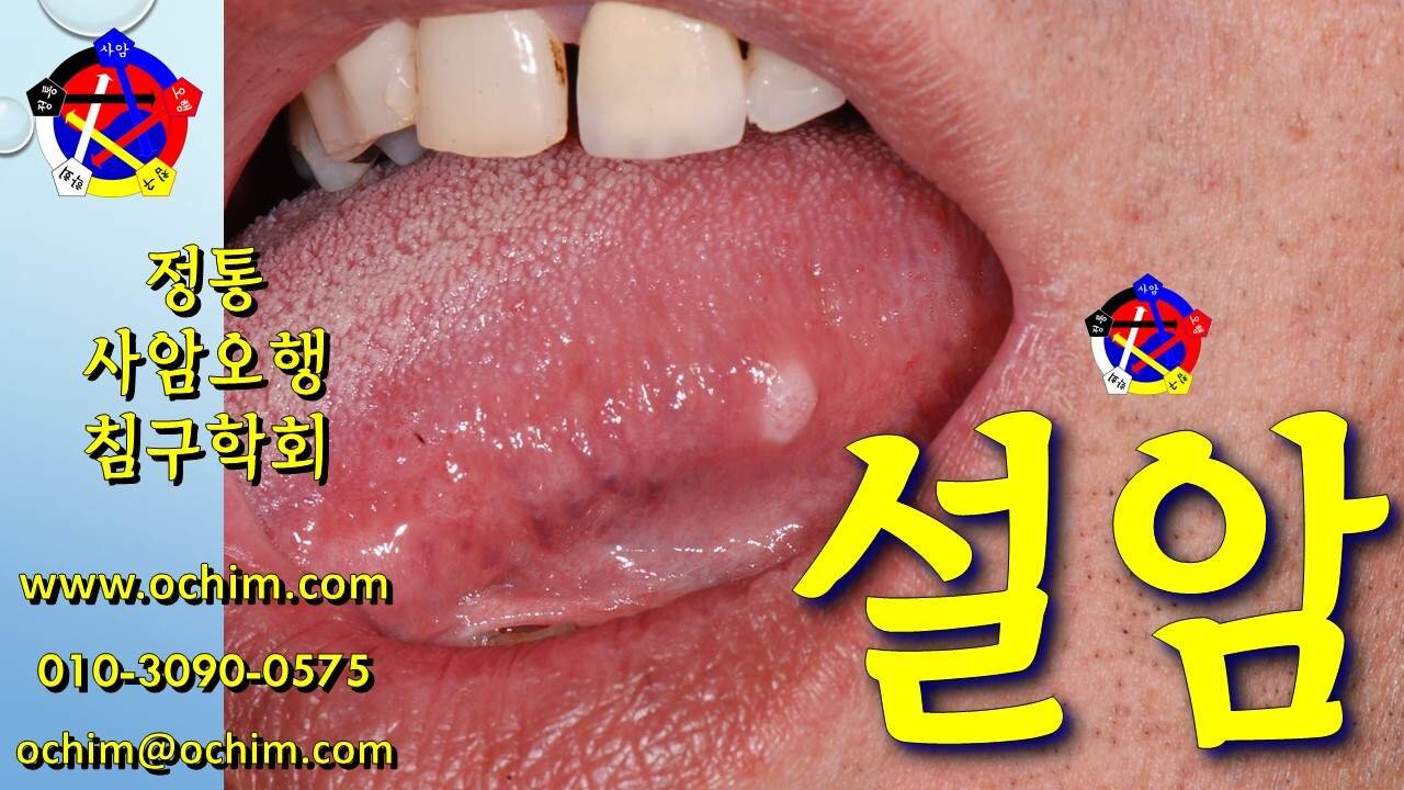 설암 치료 부작용 치료 방법 및 사례 - 사암침, 사암침법, 정통사암침 - 비과학적 양의학 217