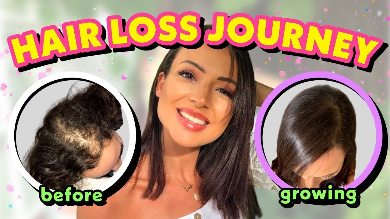 HAIR LOSS TREATMENT FOR WOMEN| MY FEMALE HAIR LOSS JOURNEY + TIPS ON HAIR LOSS