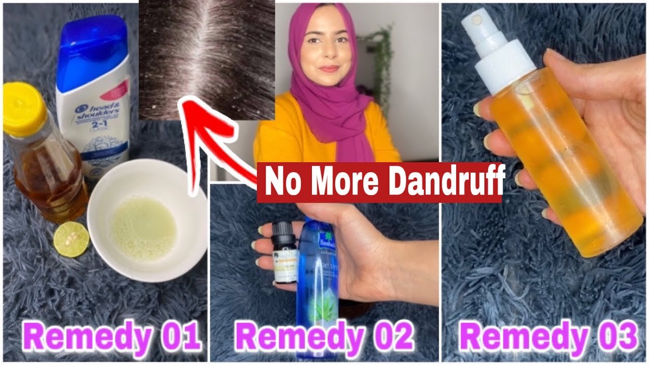 3 Best Home Remedies For Dandruff & Itchy, Dry Scalp | How to treat dandruff at home permanently 💯