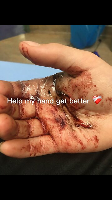 I drilled a whole in my hand 🤚 help by subscribeing to me🥹