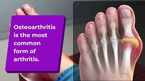 3 Types of Arthritis ( Questions, Answers & )Proven Facts ! )