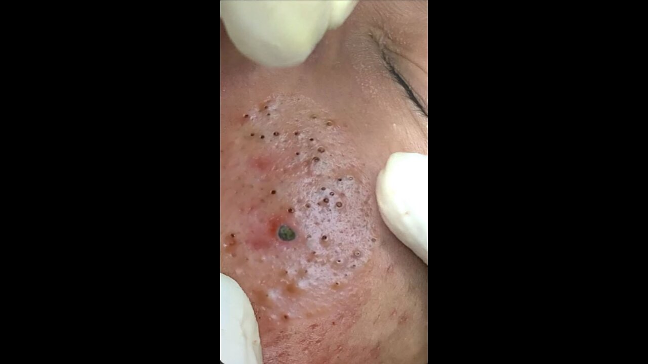 blackhead