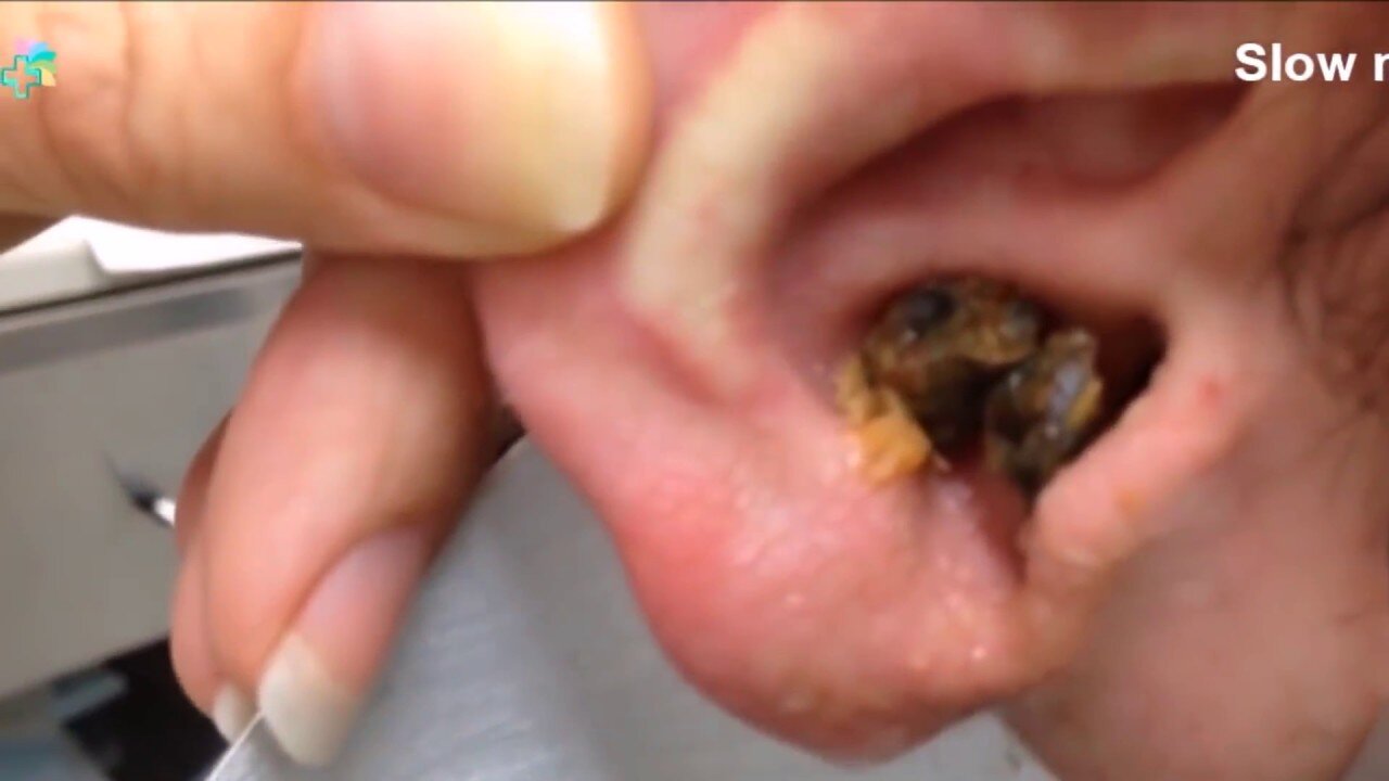 Blackhead clean in Ear