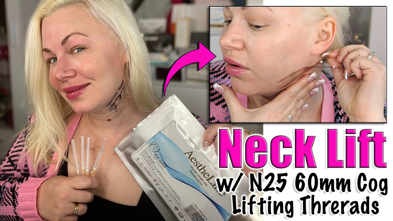 Neck Lift with N25 60mm Cog Lifting Threads from Acecosm.com | Code Jessica10 Saves you Money!