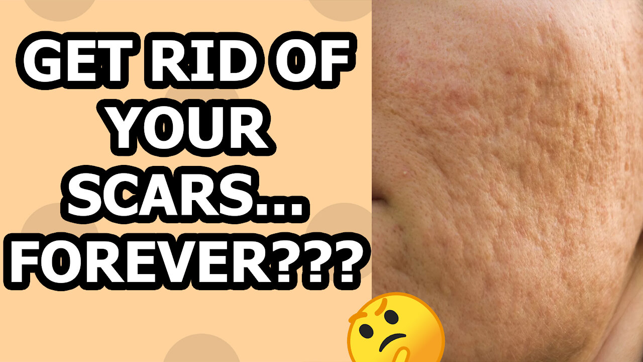 How To Get Rid Of Acne Scars - With Normal Ingredients...