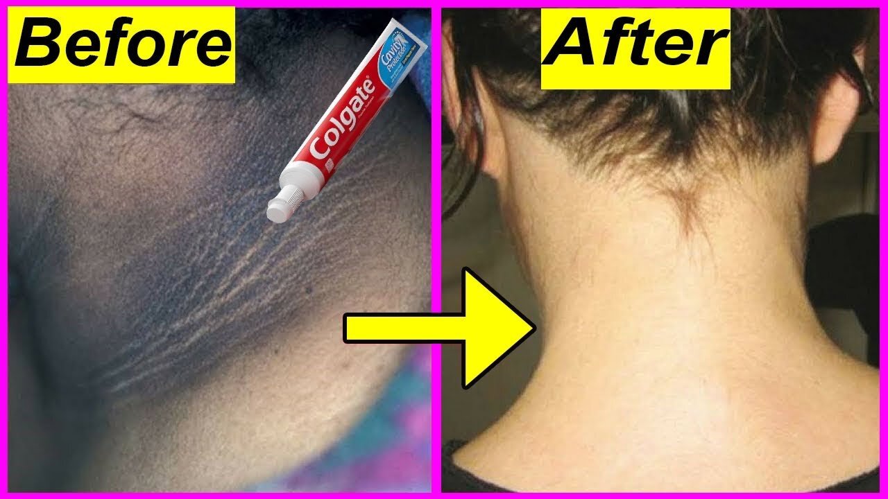 Just 5 minutes Whitening Challenge Permanently,How to Get Rid of Dark Neck Fast & Easy by Toothpaste