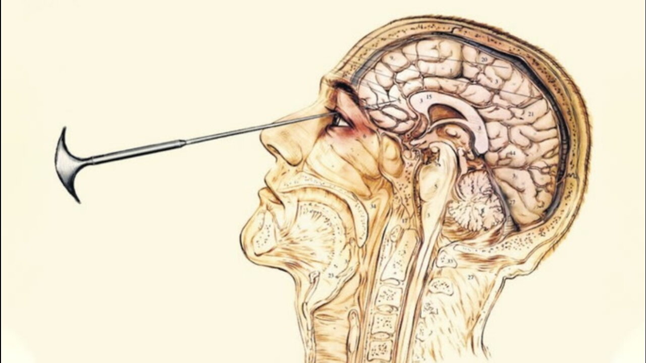 Walter Jackson Freeman II - Champion of the Lobotomy