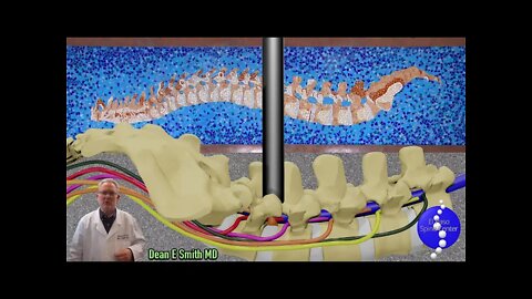 What is a MicroDiscectomy?