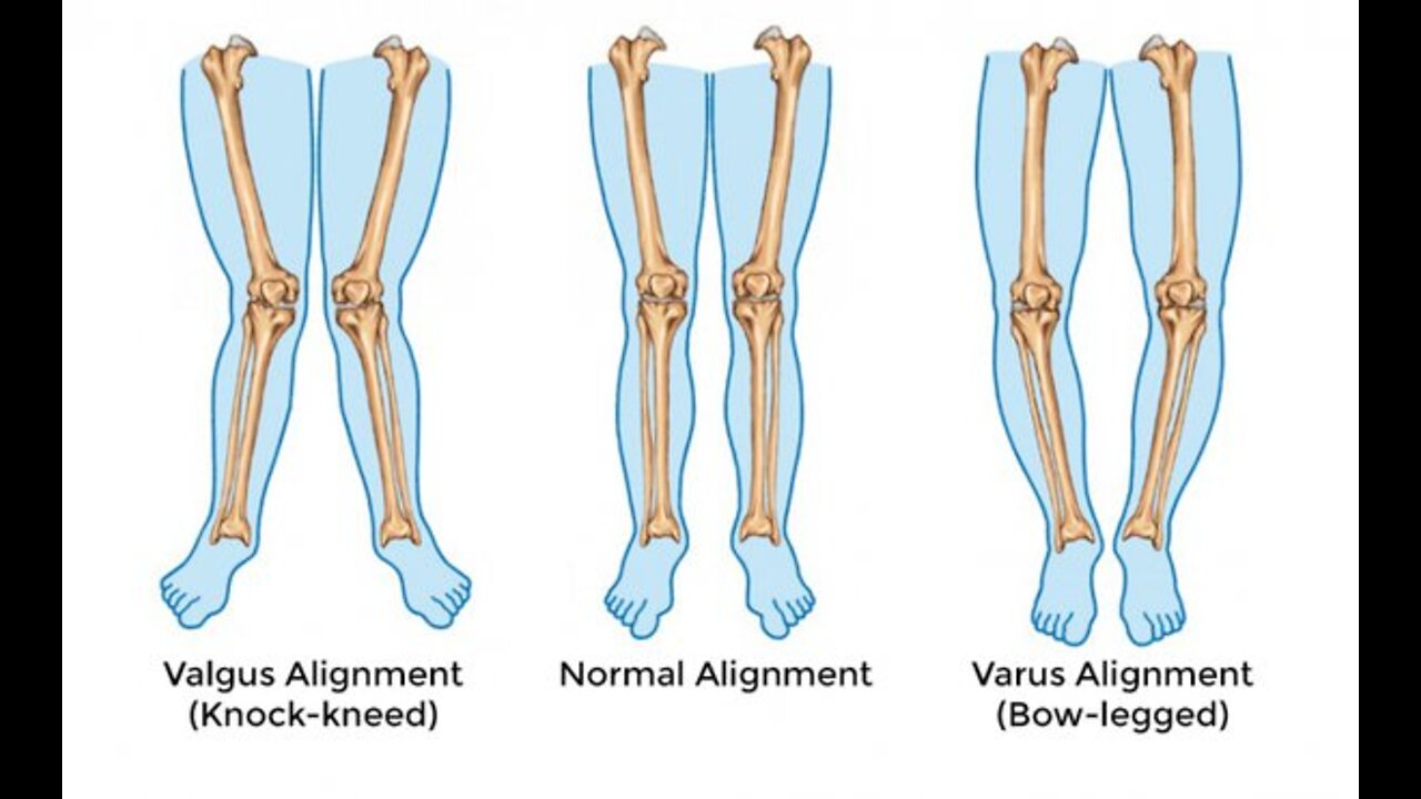 How To Straighten Your Legs Without the Surgery