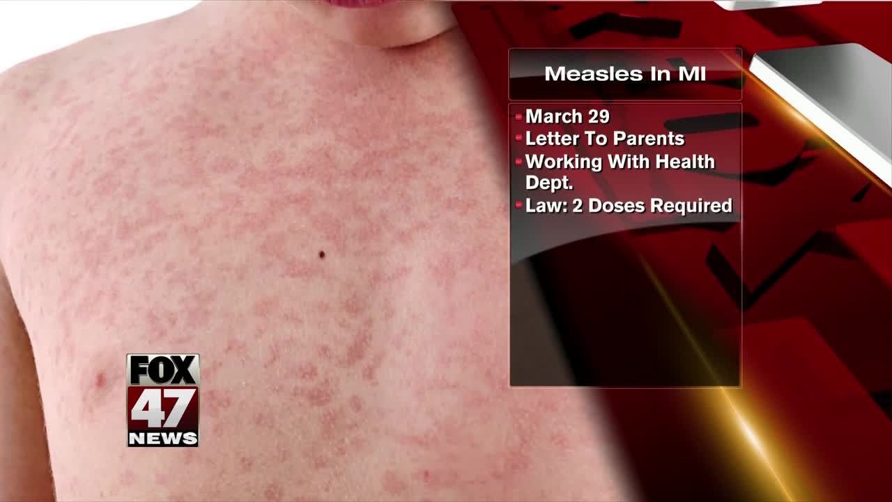 Birmingham Middle School student diagnosed with measles A