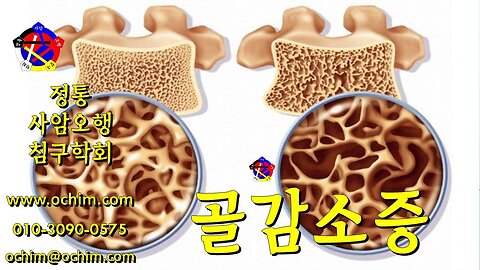 골감소증 치료 - 사암오행침, 사암침법, 오행침, 정통사암침